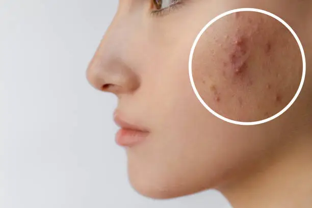 등드름 없애는법