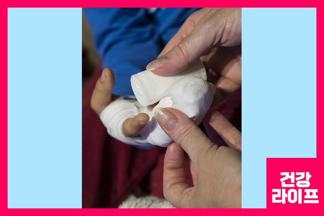 손가락 뼈가 부러질 때