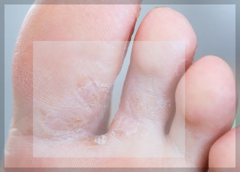발가락 사이 각화성 무좀