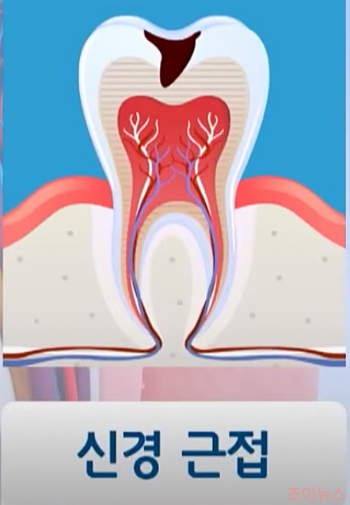 중기 충치 치료_이미지출처:케내네메디컬