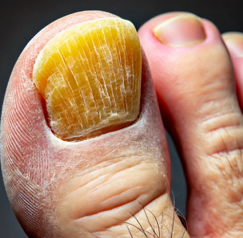 발톱무좀이 생긴 모습 : 발톱무좀약 추천이 시급하다