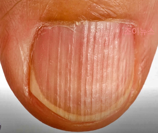 손톱에 생긴 세로줄, 원인과 대처는?