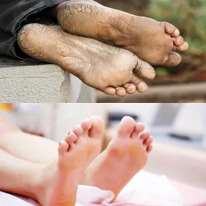 발뒤꿈치 갈라짐 비교