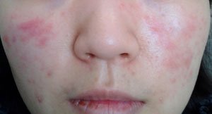 햇빛 알레르기 증상과 치료법