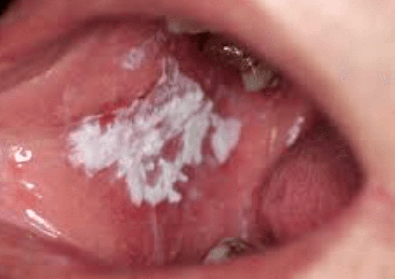 칸딘다성 구내염