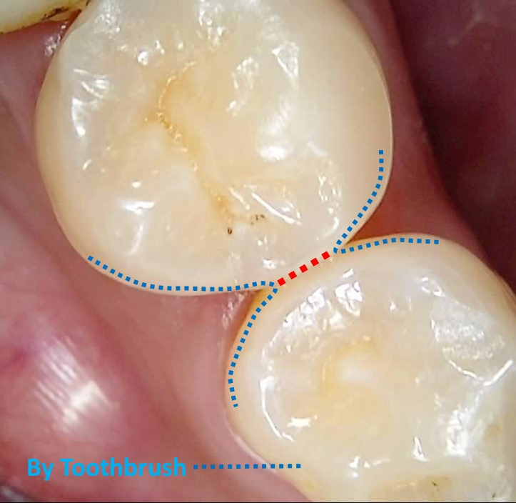 치간칫솔이 필요한 부분