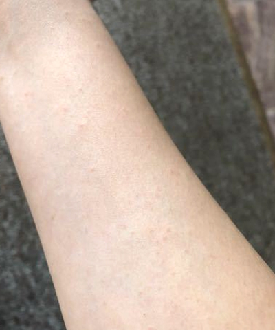 팔 좁쌀 두드러기
