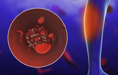 하지정맥류 증상&amp;#44; 수술비용&amp;#44; 도움이 되는 운동