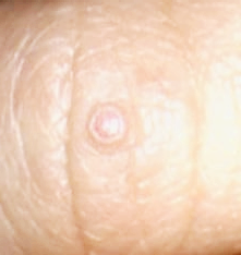 사마귀 원인과 제거방법