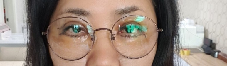 하안검 수술 후기