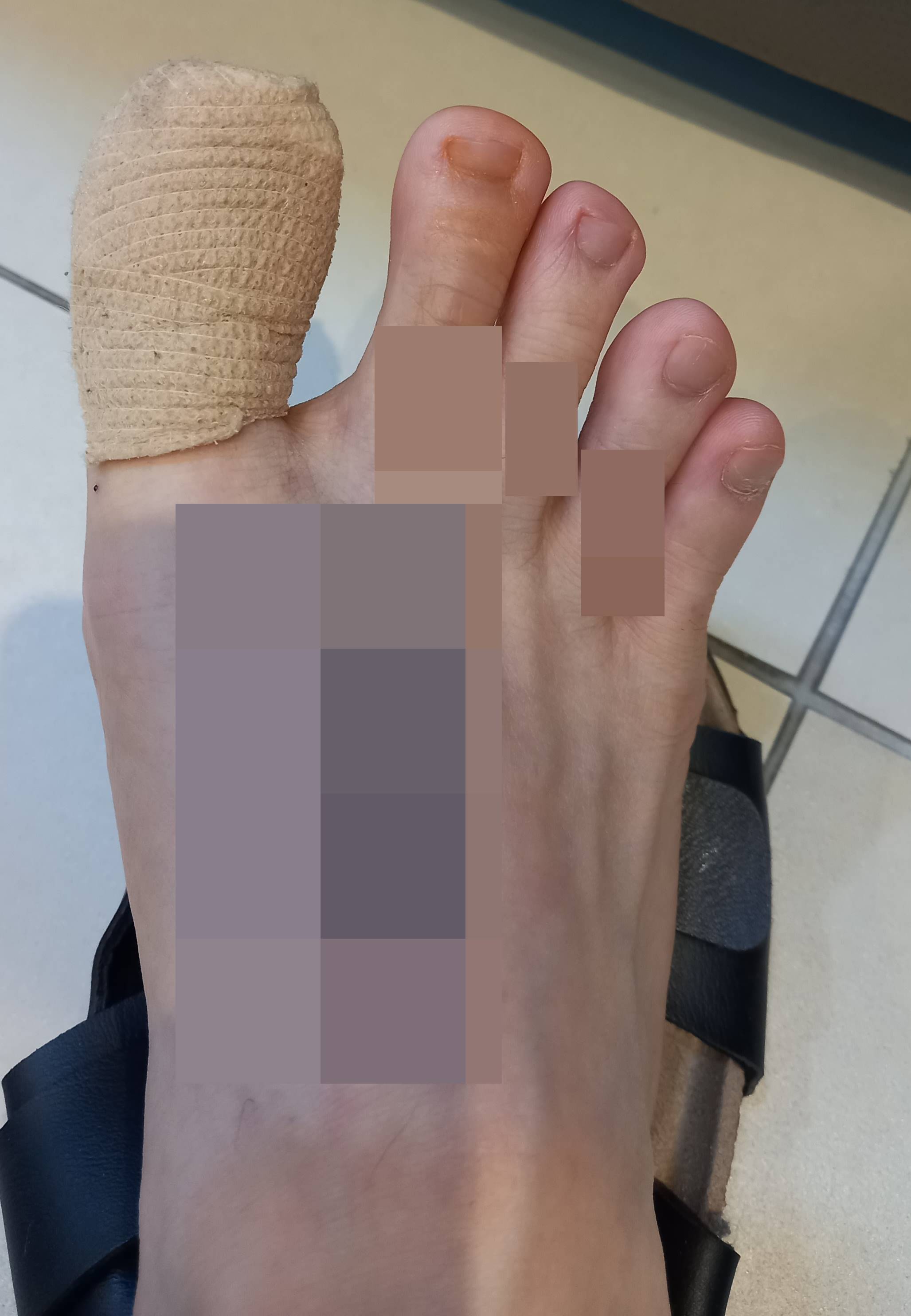 정형외과-내성발톱 수술