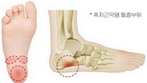 족저 근막염 통증 원인 부위