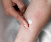 피부가려움증의 원인 27