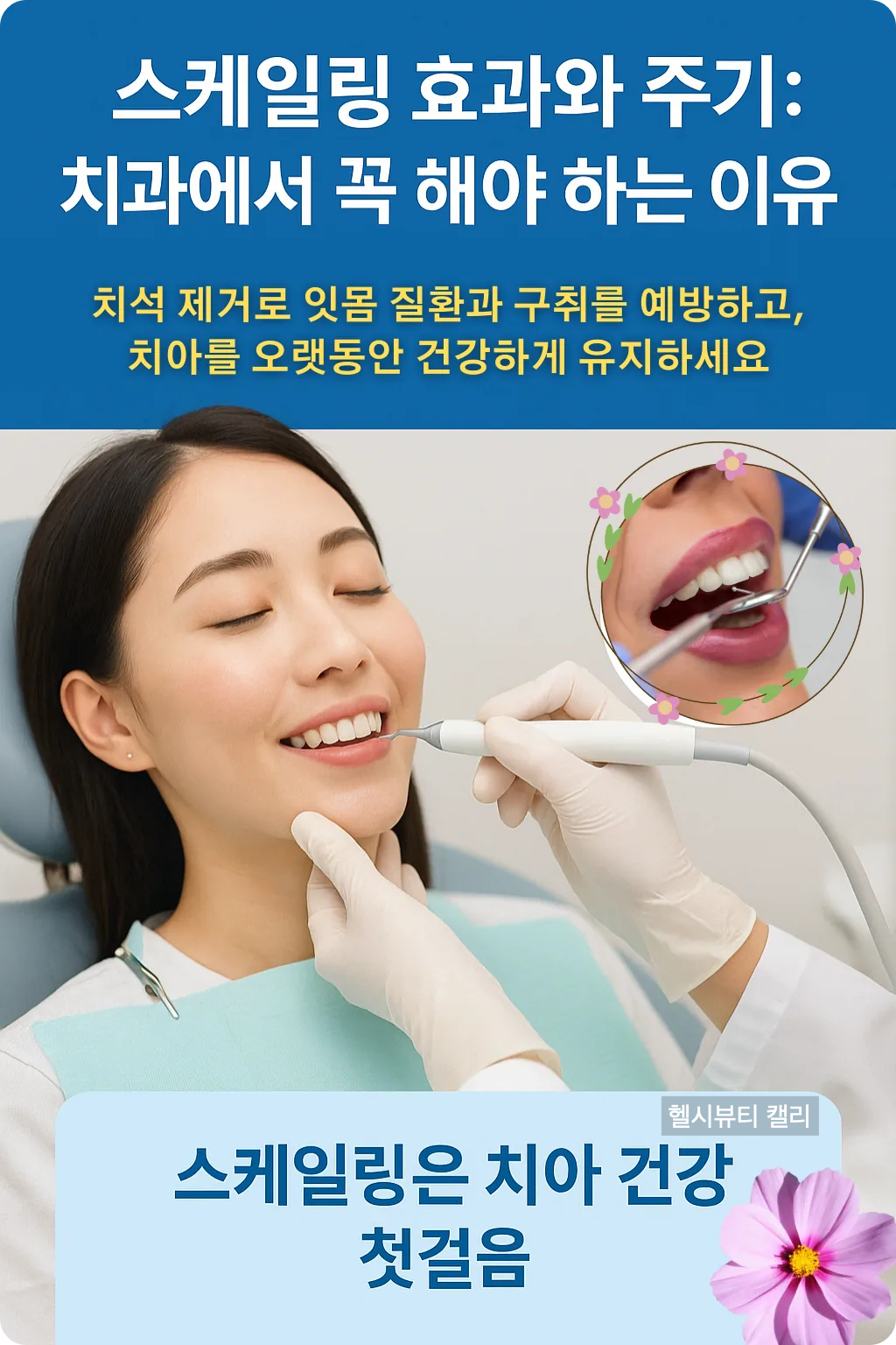 스케일링 효과와 주기를 설명하는 인포그래픽. 치과 의자에 앉아 스케일링을 받는 20대 여성의 모습과 치아 아이콘이 포함됨.