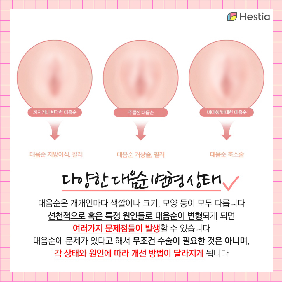 다양한 대음순변형 상태