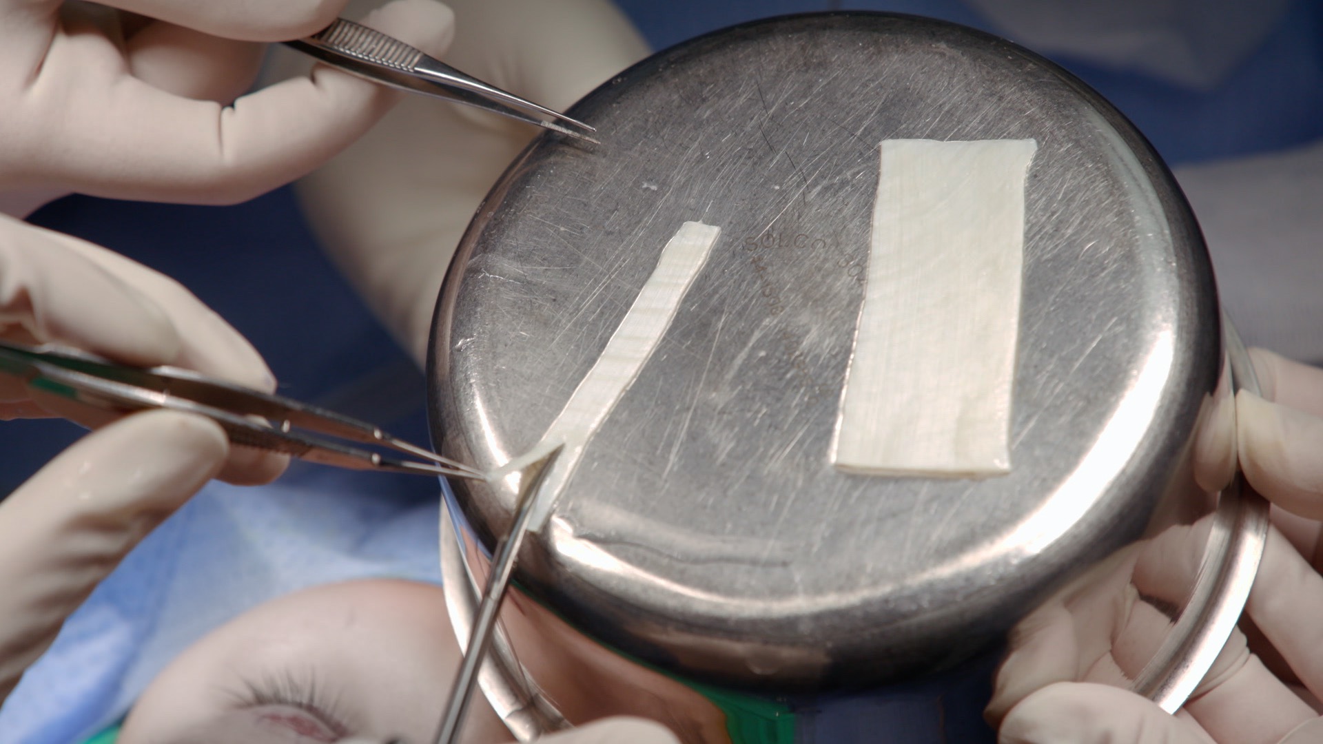 명의 안검하수 안성형