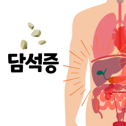 담석증