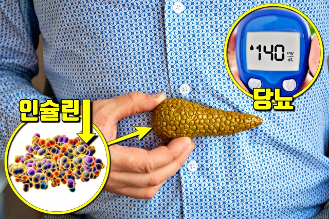 췌장암 증상 당뇨,췌장암 초기증상,췌장암 자가진단,팁줌