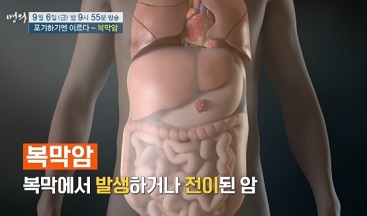 복막암