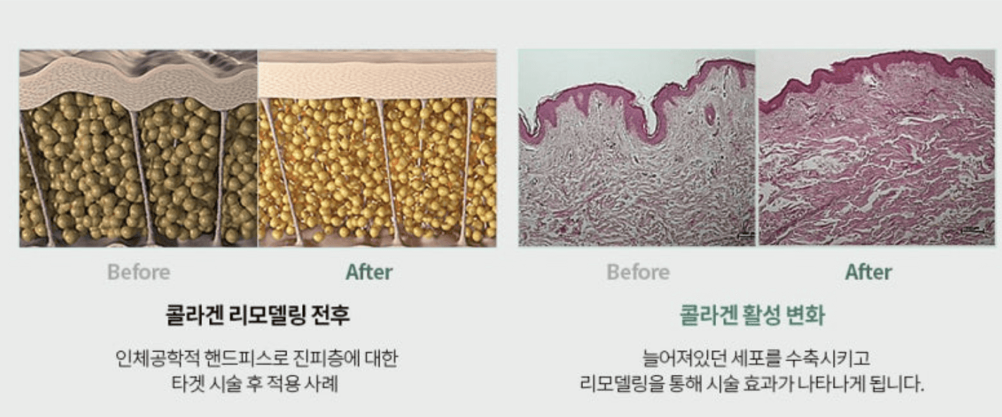 피부과리프팅레이저 시술 고민이라면? 고주파(RF) 리프팅 시술 비교 