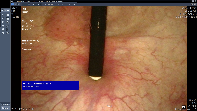 방광암 내시경 사진