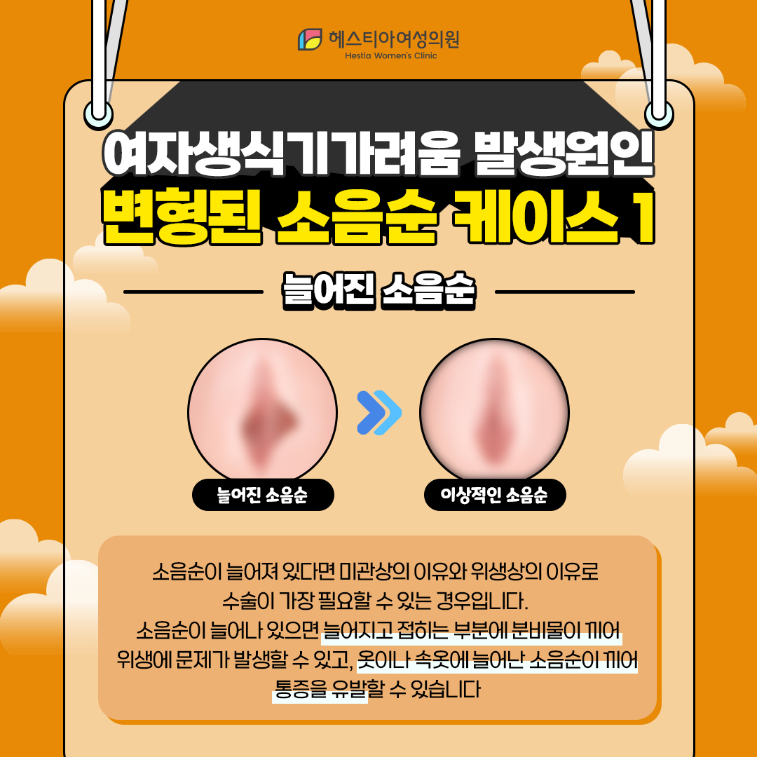늘어진 소음순