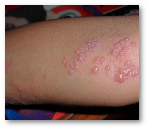  대상포진 초기증상2