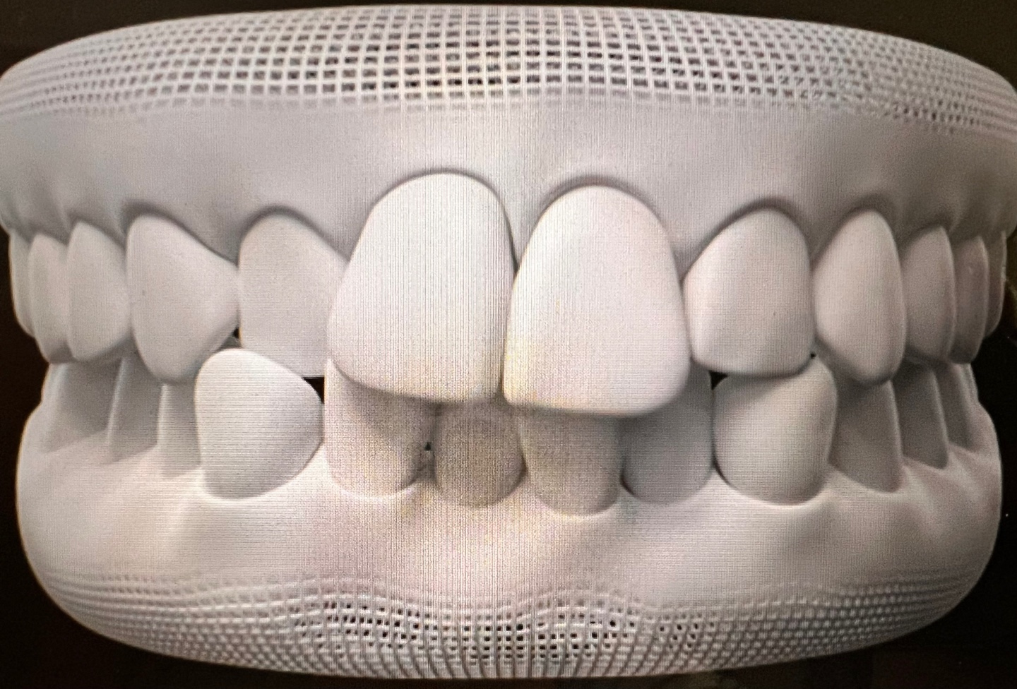 인비절라인 케이스&#44; 삐뚤빼뚤한 상태의 치아