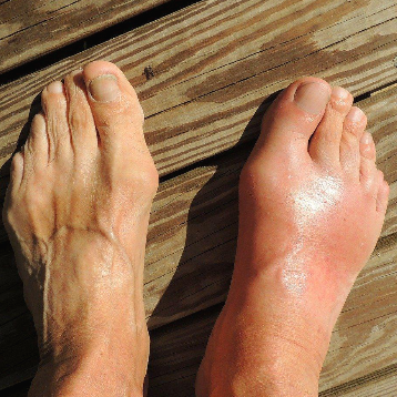 통풍 증상 발이 부음