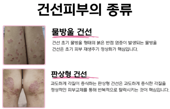 피부건조증 증상, 치료법, 좋은 음식과 연고 등 소개