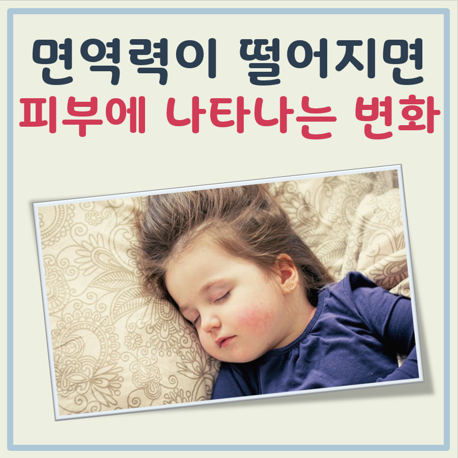 면역력이 떨어졌을때 피부