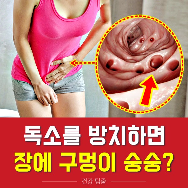 대장내시경, 장에 독소가 쌓이면, 장독소배출방법 장독소자가진단, 장게실염 대장암, 건강 팁줌 매일꿀정보