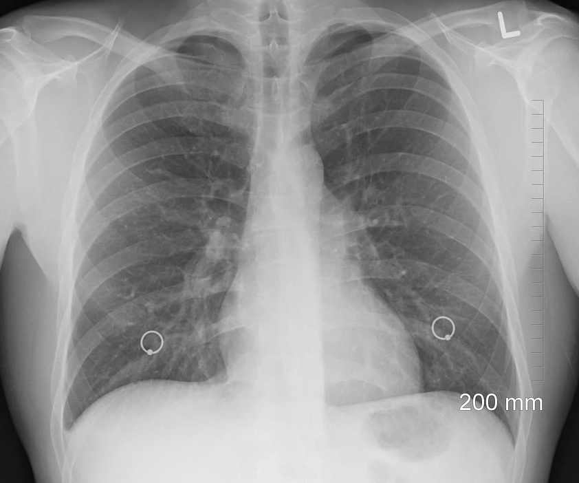 폐섬유증 초기증상과 폐에 좋은 음식5