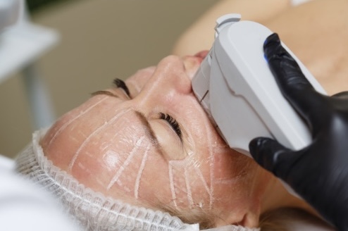 초음파를 이용한 피부 리프팅 (HIFU)