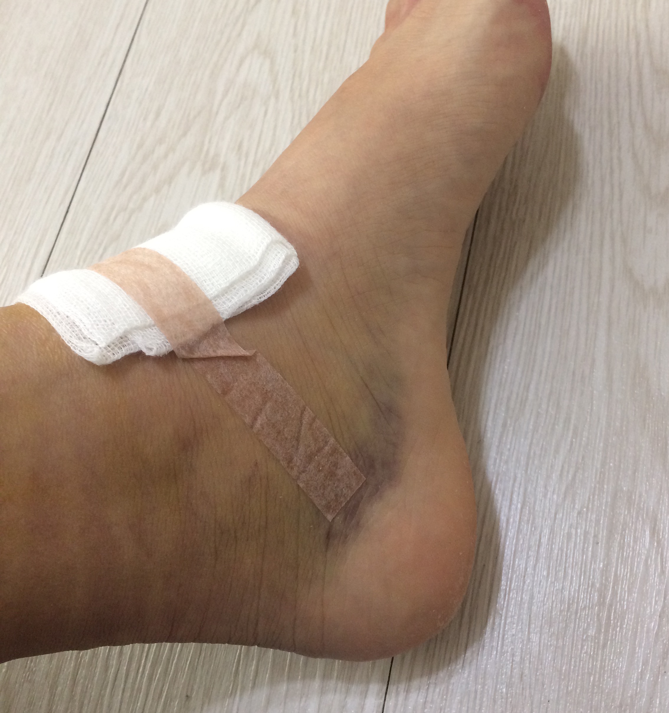 수술 후 발목사진