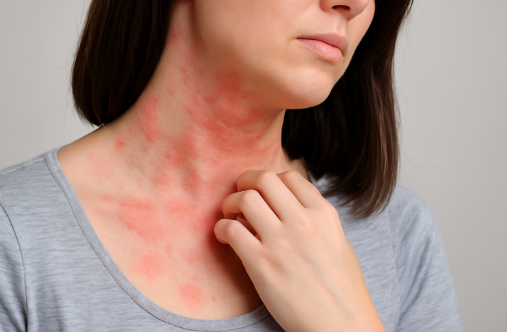 몸에 붉은 반점 원인