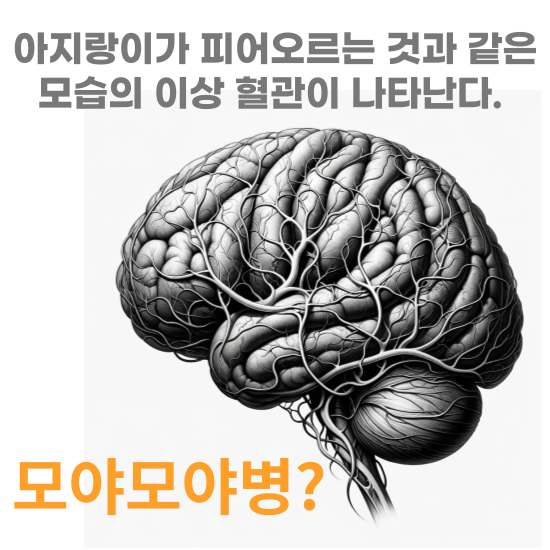 모야모야병