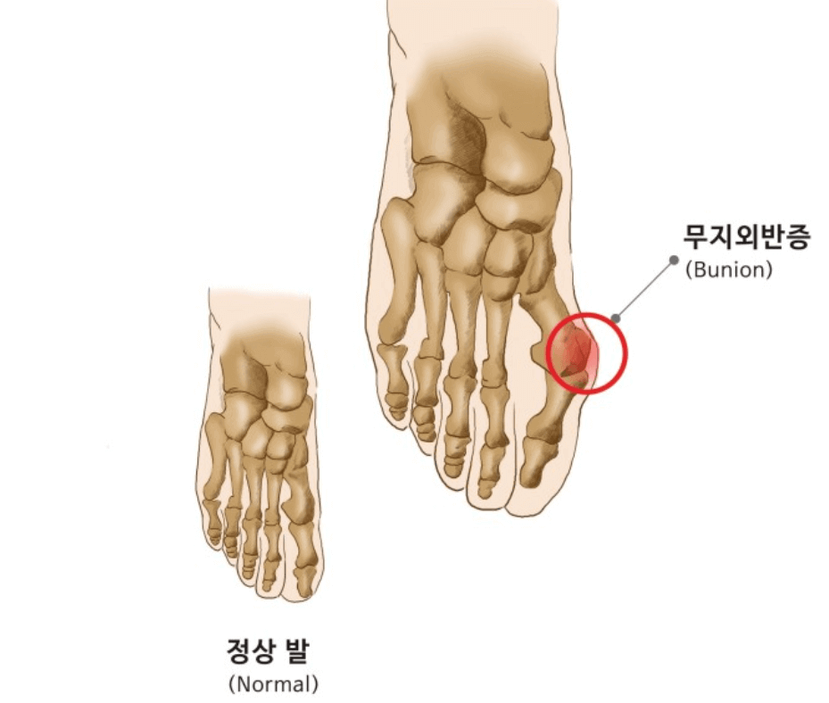 무지외반증-이미지