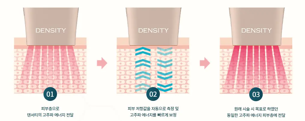 덴서티-고주파-리프팅-시술-과정