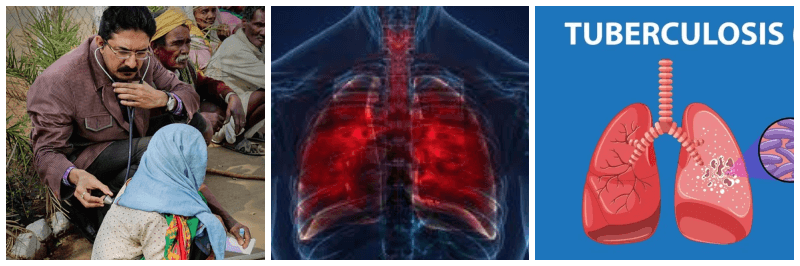 결핵 관련 사진 3개