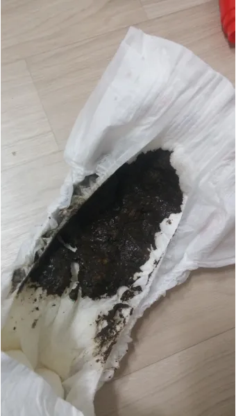 검은 변 원인 위장 출혈 가능성 있는 소화기 질환 정리_20