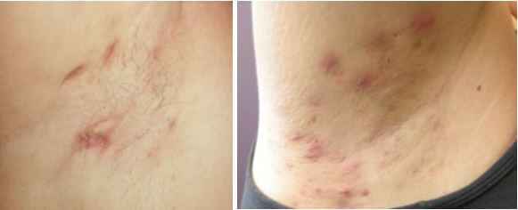 화농성 한선염 증상