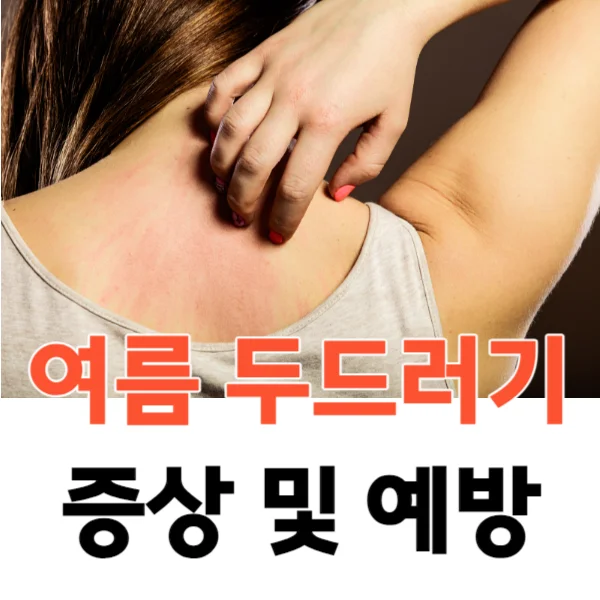 여름 두드러기 알고 예방합시다!
