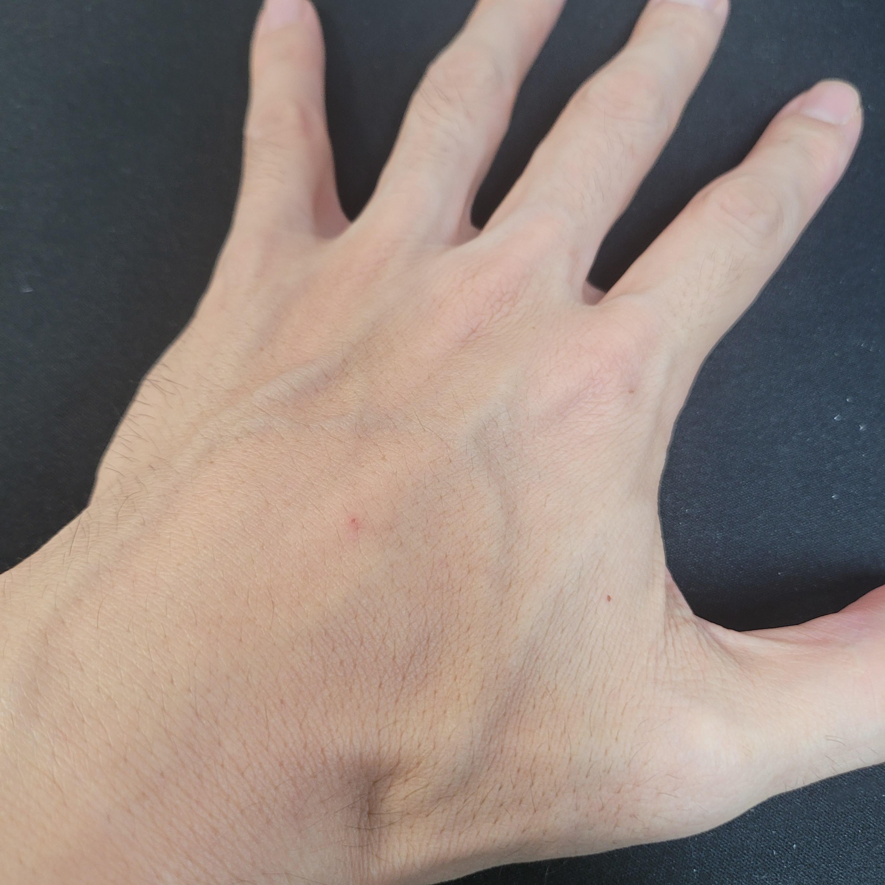 손등 핏줄 튀어나오는 이유