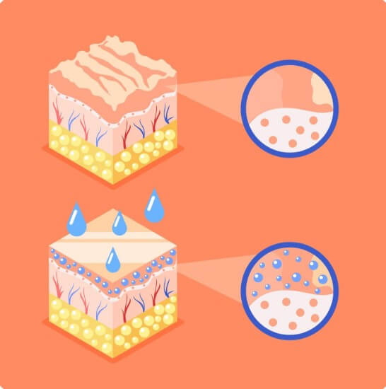 모공각화증 원인