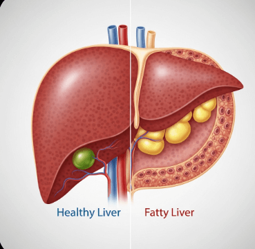 비알콜성 지방간 원인과 치료1