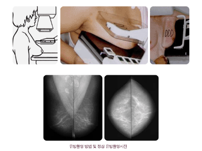 유방촬영술