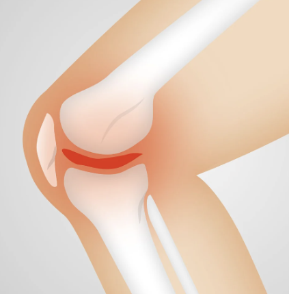 무릎통증 원인, 치료방법 섬네일