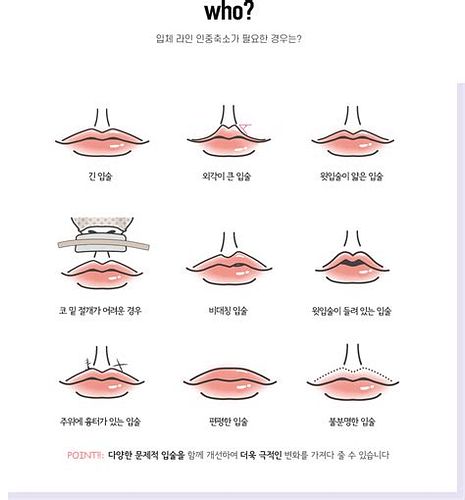 인중 축소 수술