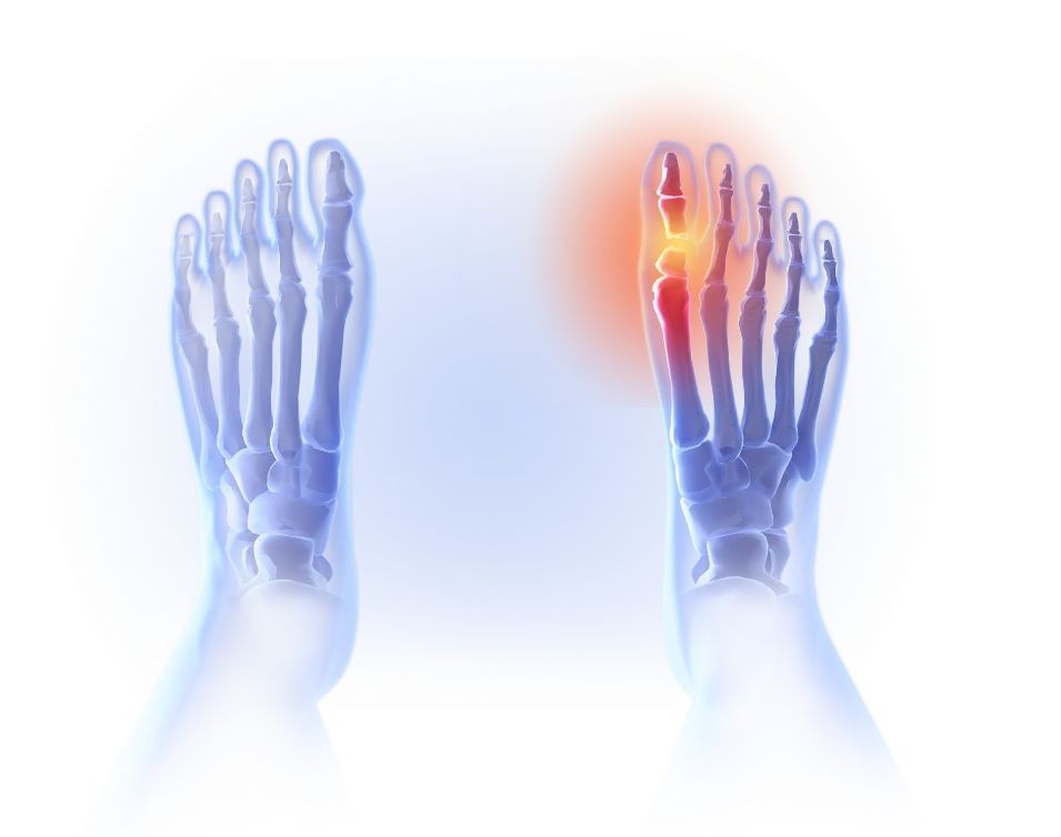 엄지발가락 통증 이미지